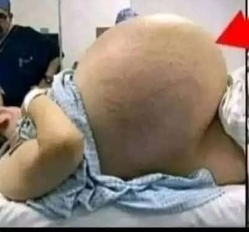 Women delivering triplets but she…See More